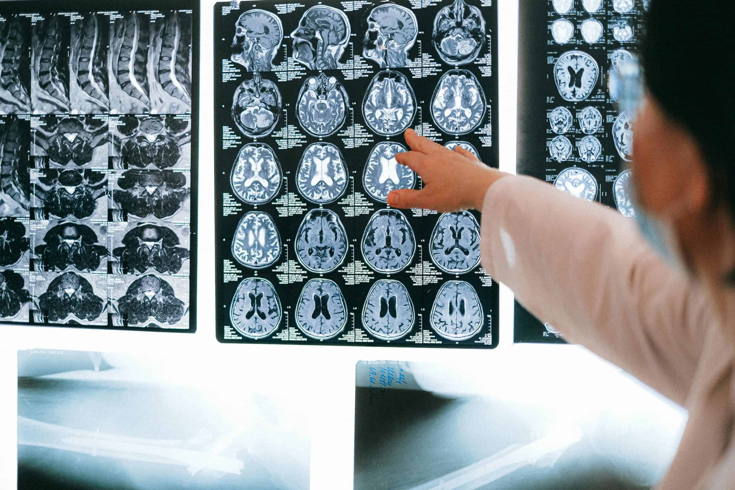 Self Care Radiologist pointing at brain MRI scans showing detailed medical examination.
