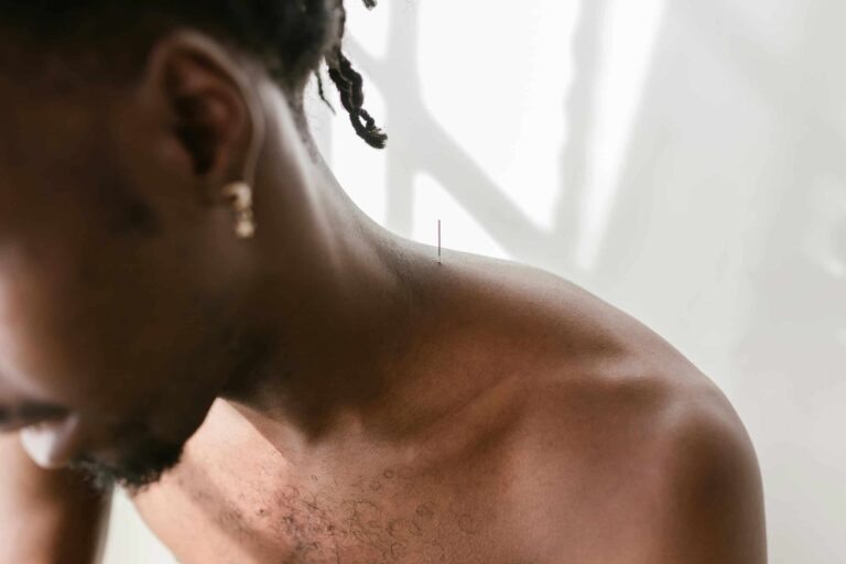 A man receiving acupuncture therapy on his shoulder for pain relief and wellness. National Motion Sickness treatment