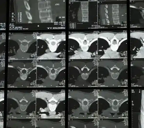 Scan of the spine in treatment for nervous system issues.